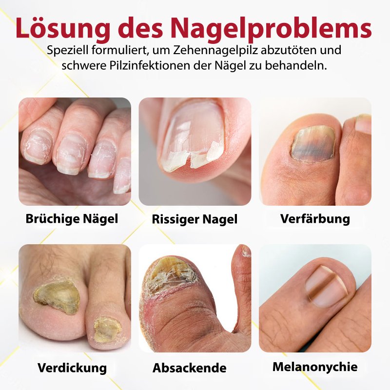 Japan NailRenew™ Onychomycosis Quick Relief Oil | 1+1 ZDARMA